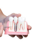 What to Expect During Dental Implant Treatment