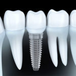 An Ultimate Guide to Dental Implants