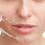 What You Need to Know Before Getting a Chemical Peel
