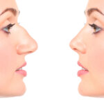 Can a Rhinoplasty Fix This?