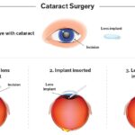 Involved In Cataract Treatment?